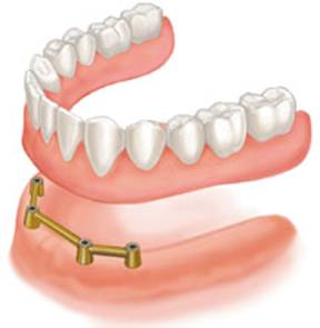 Bar Implant dentures Bar Implant Dentures