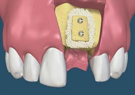 Dental Ridge Augmentation after image After Dental Ridge Augmentation