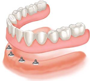 Denture supported by four implants Dentures supported by Four Implants