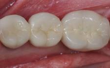 Implant bridge after After Implant Bridge