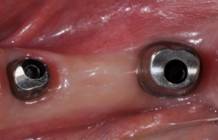 Implant bridge before Prior to Implant Bridge