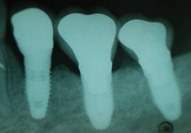 Individual implants Individual Implants