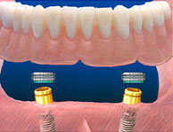 Locator attachment Implant denture Locator Attachment Implant Denture