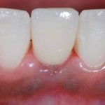 Final Restoration of Immediate Dental Implant