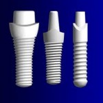 Metal Free Dental Implants Portland OR